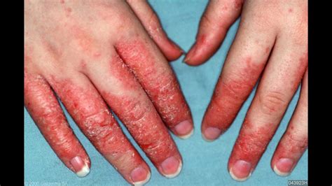 Natural Eczema Cure And Remedy How To Get Rid Of Dry Hands Youtube