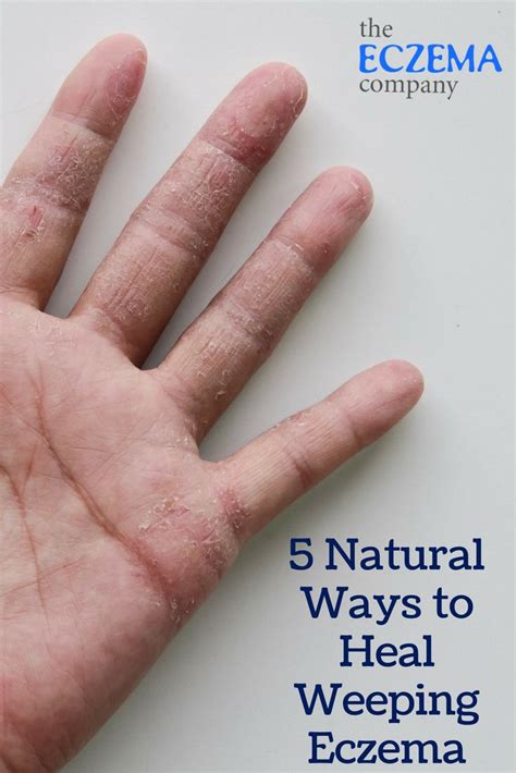Weeping Eczema Natural Ways To Heal Healing Eczema Pictures