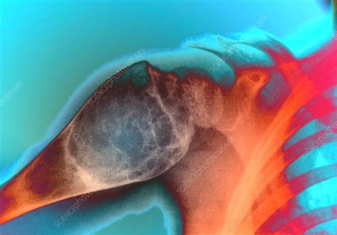 Aneurysmal Bone Cyst X Ray Stock Image C0528211 Science Photo