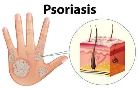 Everything You Need To Know About Psoriasis Symptoms Causes