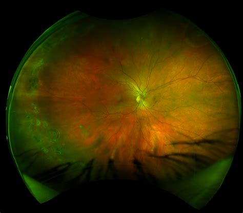 What The Fundus New Website For Sharing Optos Retinal Images Eyedolatry