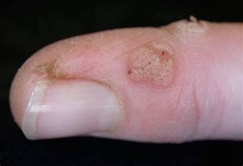 Health Check Do Home Remedies For Common Warts Really Work