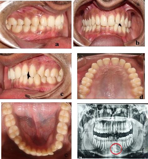Figure 3 From Transmigration Of Mandibular Canines A Review Of The
