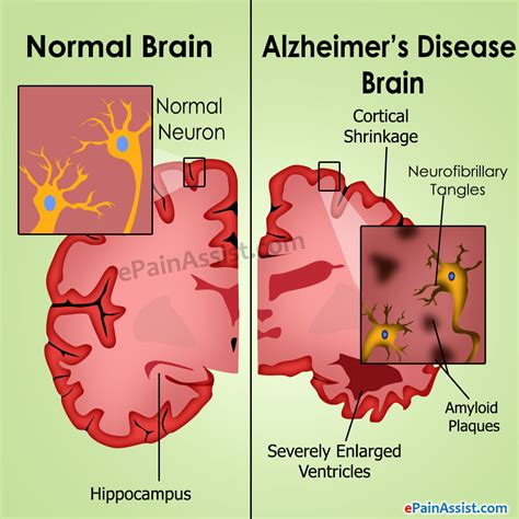 alzheimer s disease causes stages treatment prognosis
