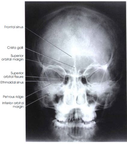 The ap skull view has a higher radiation dose to the eyes than the pa view, and it has higher magnification of the bones. PA AXIAL SKULL SERIES | CALDWELL METHOD - RadTechOnDuty
