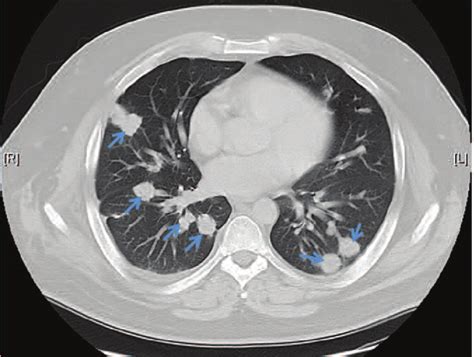 Ct Scan Of The Chest Without Contrast Showing Numerous Non Calci Fied