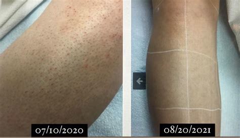 F Months Laser Hair Removal Before And