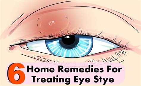 6 Home Remedies For Treating Eye Stye Home So Good Essential Oils