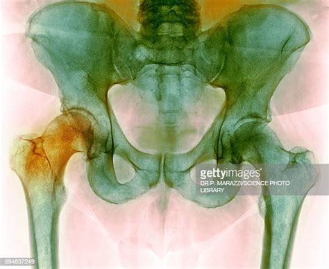 Hip Replacement X Ray Photos And Premium High Res Pictures Getty Images