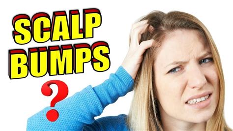 Why Do I Have Bumps On My Scalp How To Get Rid Of Scalp Acne