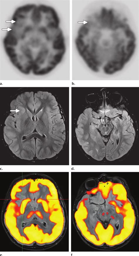 Focal Cortical Dysplasia In A 9 Year Old Boy With In Tractable