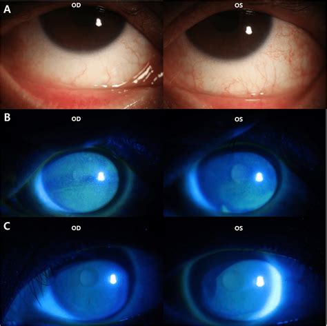At 3 Weeks No Conjunctival Pseudomembrane Was Observed A But