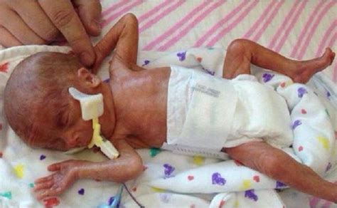 Baby Born At 23 Weeks Doing Well After Parents Post Photo To Stop Late