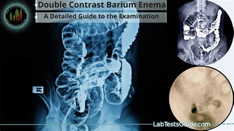 Double Contrast Barium Enema A Detailed Guide To The Examination