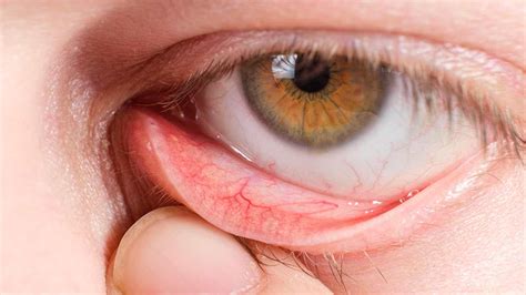 Clinical Challenges Tackling Dry Eye Disease Medpage Today