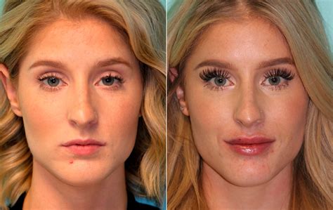 Lip Augmentation Photos Chevy Chase MD Patient 16116