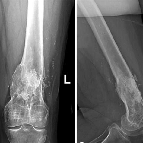 Ap And Lateral Views Plain Radiographs Of The Left Distal Femur After