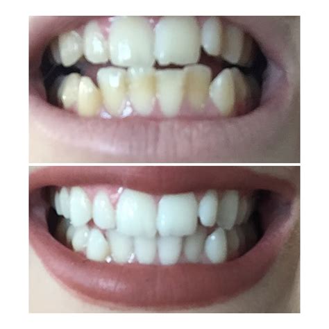 My Teeth Whitening Transformation Before And After Sleek Chic