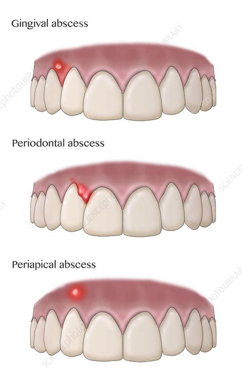 Types Of Dental Abscesses Illustration Stock Image C0366292