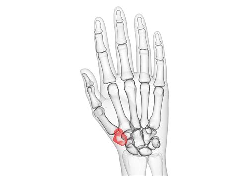 Does Removing The Trapezium Bone Help Thumb Arthritis