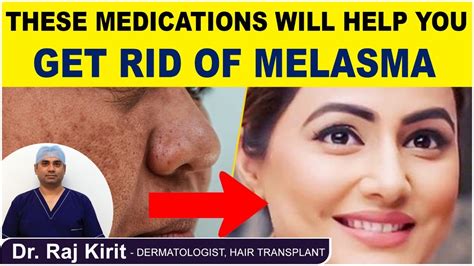 How To Get Rid Of Melasma On Face Naturally Melasma Treatment