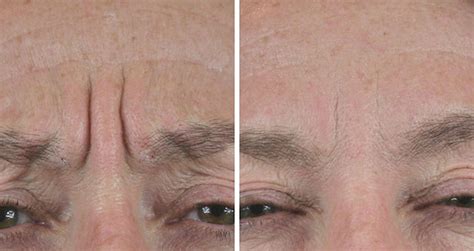 Frown Line Removal With Botox Beautiphi Auckland