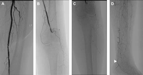 Diagnostic Angiography Of The Left Leg A Stenosis In Mid Superficial