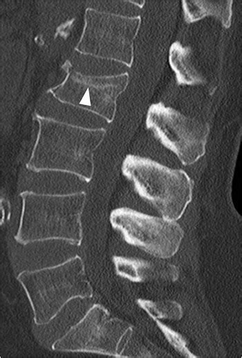 Section 3 Trauma To Uncompromised Spine Radiology Key