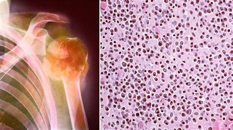 How Multiple Myeloma Is Diagnosed Everyday Health