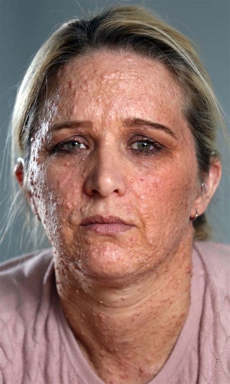 brave mum battling extreme bubble like skin condition that leaves her looking like she s been