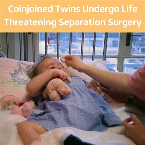 Conjoined Twins Undergo Life Threatening Separation Surgery After