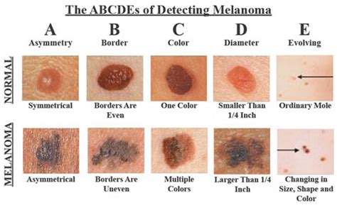 How To Recognize Skin Cancer This Could Save Your Life The Health