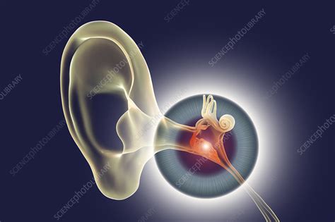 Otitis Media Ear Infection Illustration Stock Image F0325957