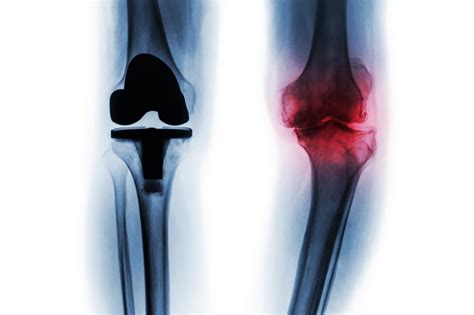 Medical Advancements And Technology In Total Knee Replacement Surgery