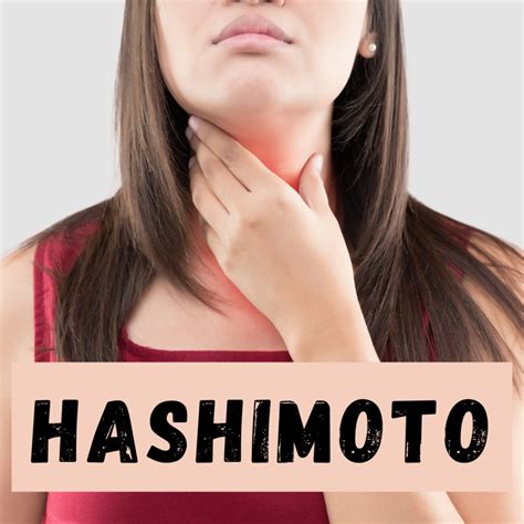 Hashimoto Choroba Autoimmunologiczna Przyczyny Objawy Zdrowy Start