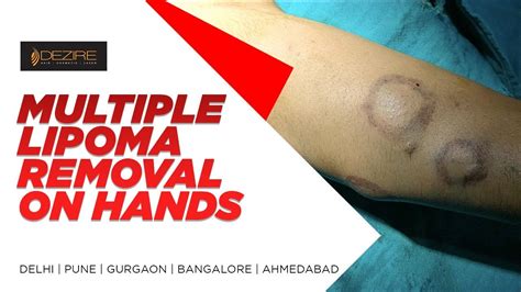 Best Multiple Lipoma Removal From Patient Hands By Dr Prashant Yadav