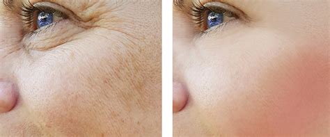 9 Skin Rejuvenation Treatments That Can Make You Look Younger Skinkraft