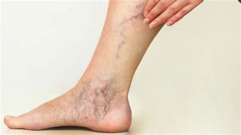 Advanced Veins Vascular Management Blood Clot Legs Treatment Jackson MI