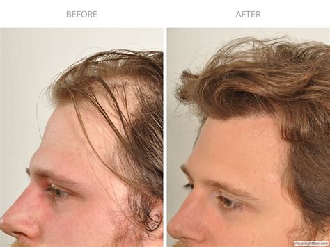 Hair Transplant Before After Photo Gallery Haircaremd Nyc