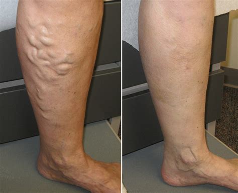 Updates In Varicose Vein Treatment Department Of Surgery