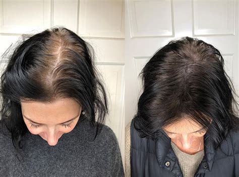 8 Tips On How To Use Coffee For Hair Growthbefore And After Pics