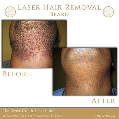 Laser Hair Removal Swansea Laser Treatment Hair Removal