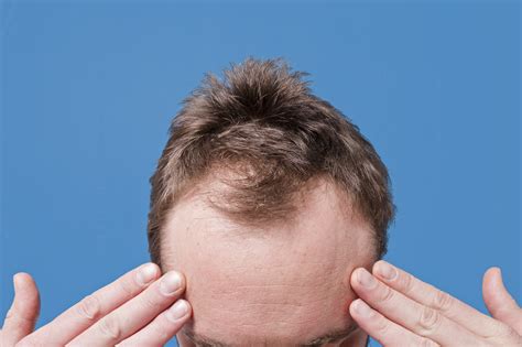 For men suffering from hair loss, causes range from hereditary traits to underlying medical conditions to lifestyle choices and more. Hair Loss and Male Pattern Baldness (Androgenic Alopecia ...