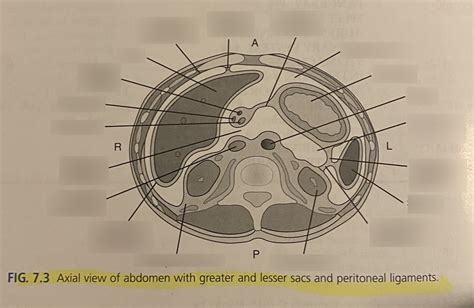 Axial Abdomen Wgreater And Lesser Sacs And Peritoneal Ligaments