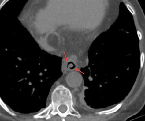 Ct Chest Demonstrating Soft Tissue Nodule In Distal Esophagus Likely