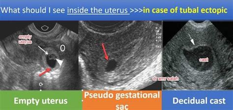 Ectopic Pregnancy What Ultrasound Guided Tips
