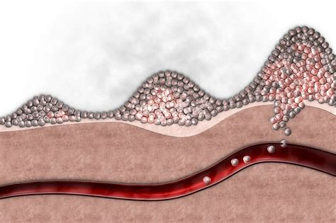 What Does Cancer Metastasis Have To Do With Wound Healing More Than