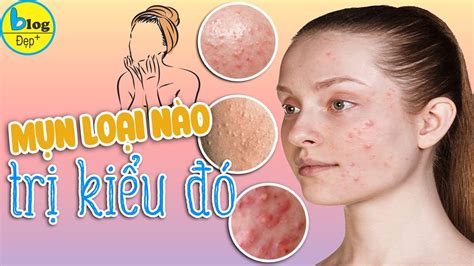 Phân Biệt Các Loại Mụn Thường Gặp Và Công Thức Trị Mụn đỉnh Cao Tóm