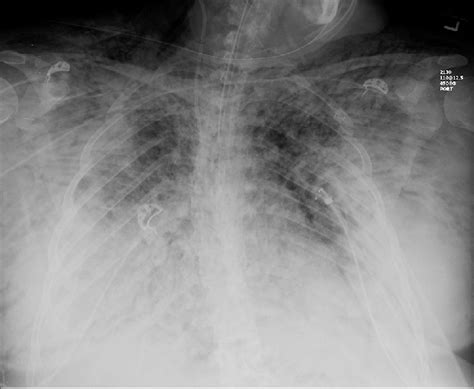 Chest X Ray Demonstrating Subcutaneous Emphysema Download Scientific