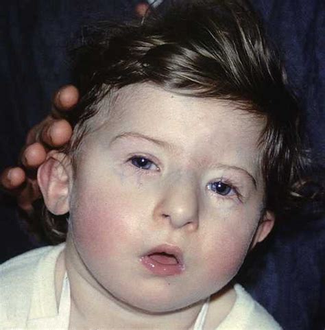 Prader Willi Syndrome Pictures Symptoms Life Expectancy Treatment